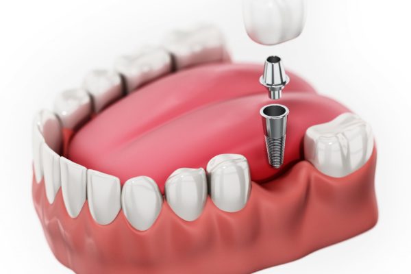 single-tooth-dental-implants-scaled